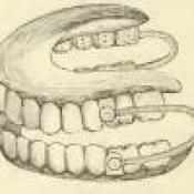 denture